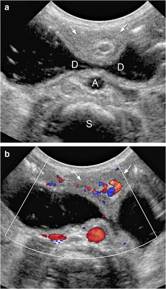 Diagnostic Accuracy of Ultrasound in Determining the Cause of Bilious Vomiting in Neonates {faces}